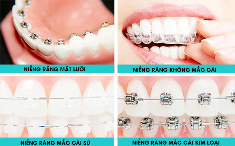 Giá niềng răng 1 hàm có sự khác nhau tùy theo phương pháp niềng được lựa chọn
