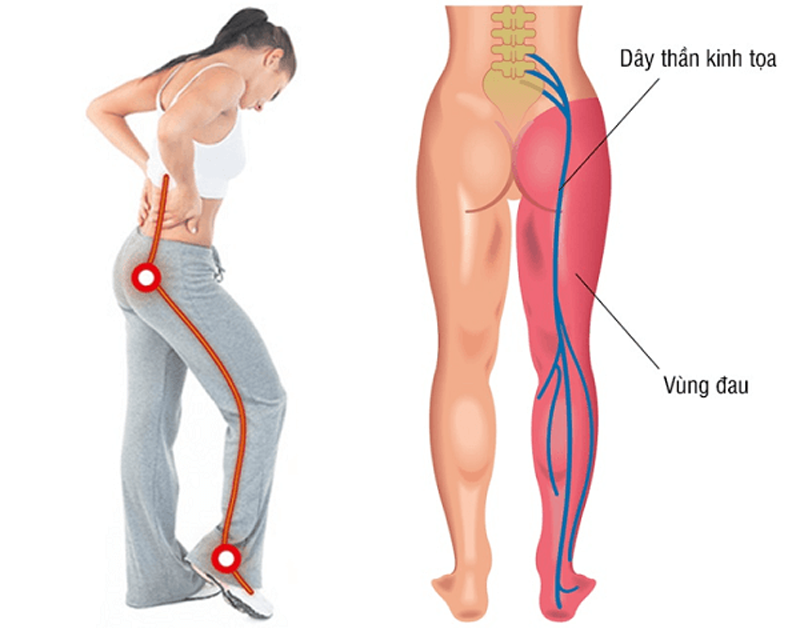 Dây thần kinh tọa bị viêm, tổn thương gây đau từ thắt lưng xuống chân