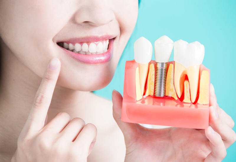 Trồng răng implant giúp đảm bảo tính thẩm mỹ