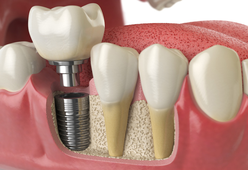 Phương pháp trồng răng implant có nhiều ưu điểm