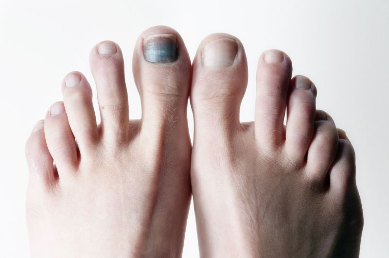 Hầu hết móng chân bị dập là do tác động từ bên ngoài không phải bệnh lý