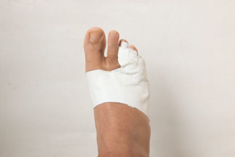Nếu móng chân bị dập quá nặng nên xử lý và băng bó để tránh nhiễm trùng
