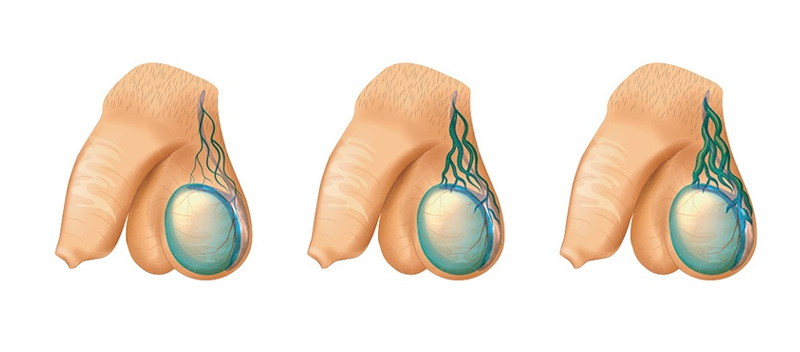 Mạch máu nổi ở tinh hoàn do các tĩnh mạch thừng tinh bị giãn nở