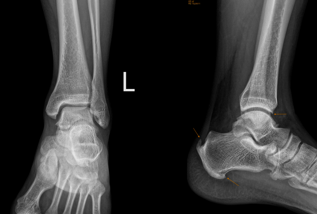  Chụp X - quang chân