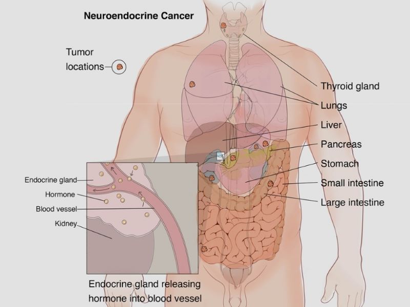 Ung thư thần kinh nội tiết có thể xảy ra ở nhiều cơ quan khác nhau