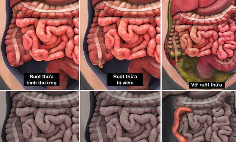 Vỡ ruột thừa gây tràn dịch mủ, vi khuẩn ra ổ bụng