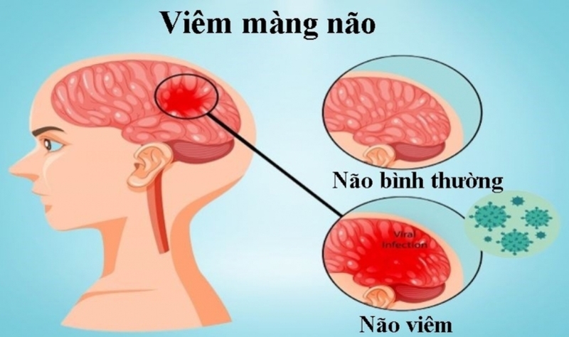 Viêm màng não là một căn bệnh phổ biến ở trẻ em và người lớn tuổi có hệ miễn dịch yếu kém