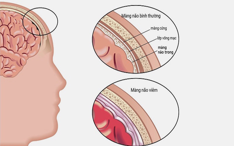 1. Giới thiệu về bệnh viêm màng não