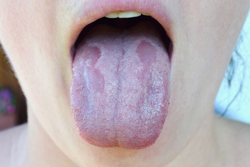 Nấm miệng là tình trạng phổ biến do nấm Candida gây ra 