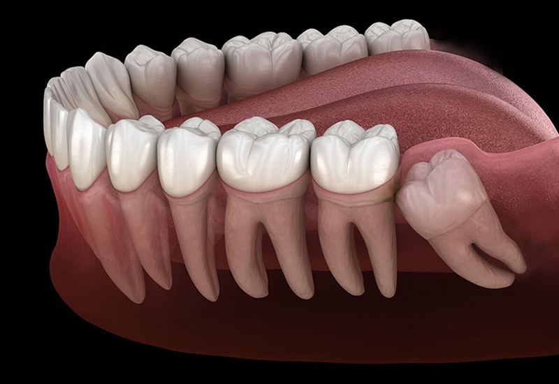 Tình trạng nhiễm trùng có thể xảy ra sau khi nhổ răng khôn gây đau nhức?
