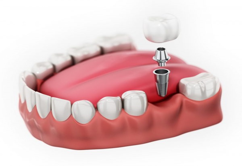 Trồng răng implant giúp phòng tránh nguy cơ tiêu xương hàm