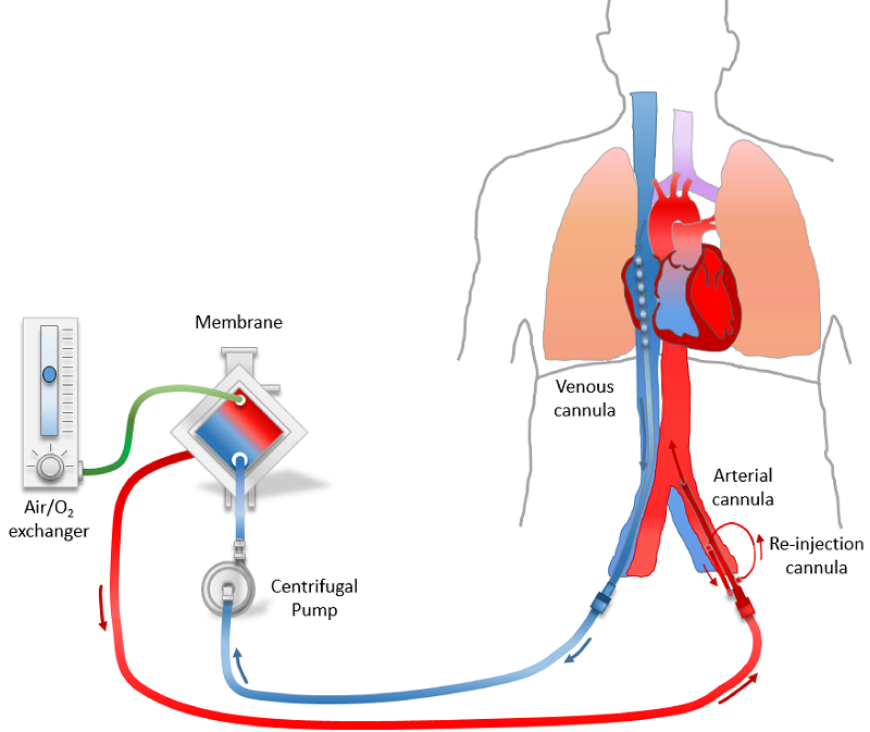 Máy tim phổi nhân tạo được sử dụng trong tuần hoàn ngoài cơ thể để làm gì?
