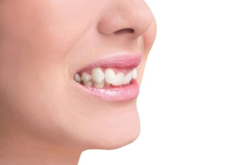 Răng khểnh tự nhiên hình thành do nhiều nguyên nhân