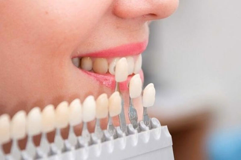 Có rất nhiều phương pháp trồng răng khểnh