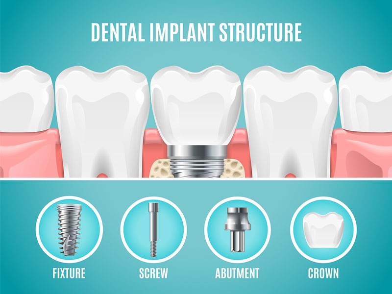 Răng Implant gồm nhiều phần khác nhau