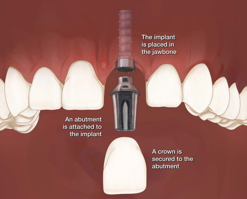 Trồng Implant răng cửa là phương pháp hiện đại