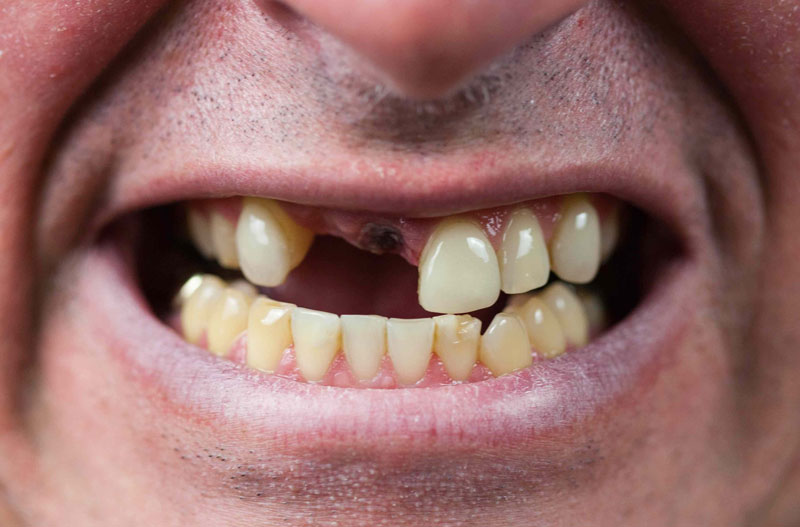 Nhiều trường hợp bị mất răng cửa vì các nguyên nhân khác nhau