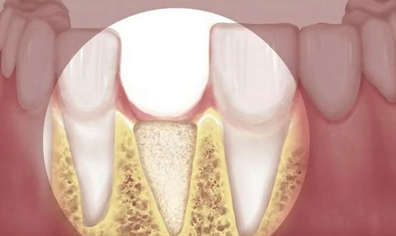Răng cửa bị mất trong thời gian dài có thể gây tiêu ổ xương