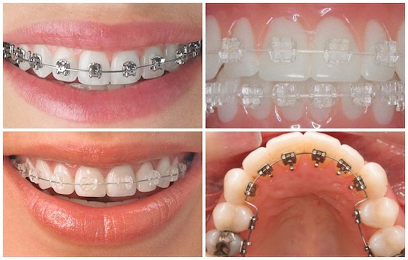 Tùy theo từng giai đoạn mà vai trò của dây cung trong niềng răng sẽ khác nhau