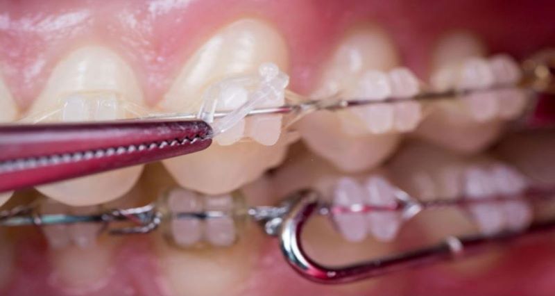 Quá trình đeo dây niềng răng cần được thực hiện bởi bác sĩ có chuyên môn