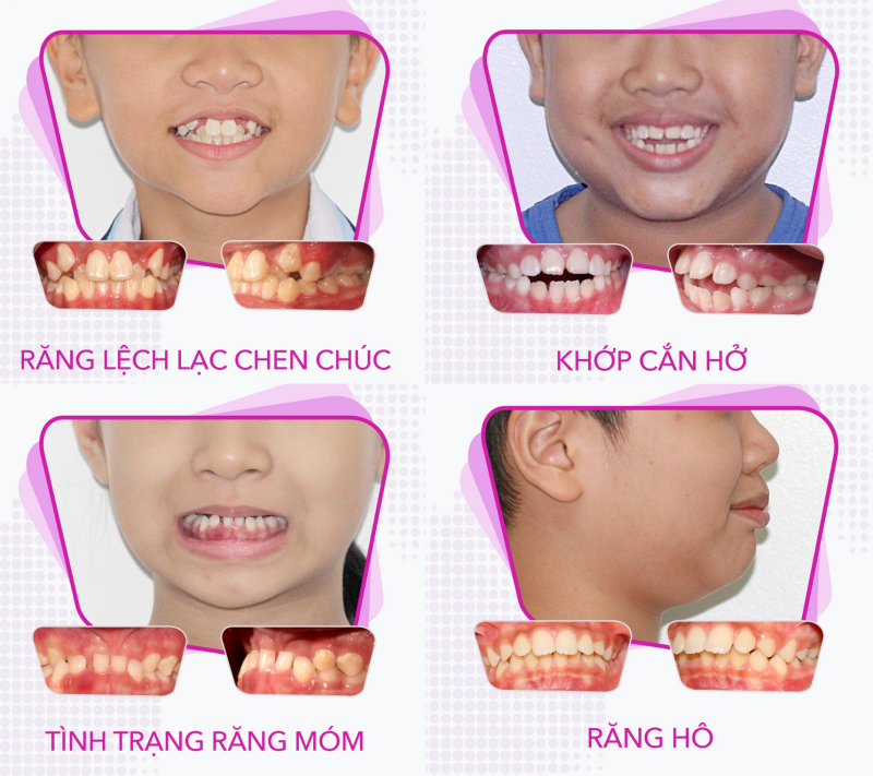 Niềng răng giúp khắc phục nhiều vấn đề bất thường về răng - hàm của trẻ