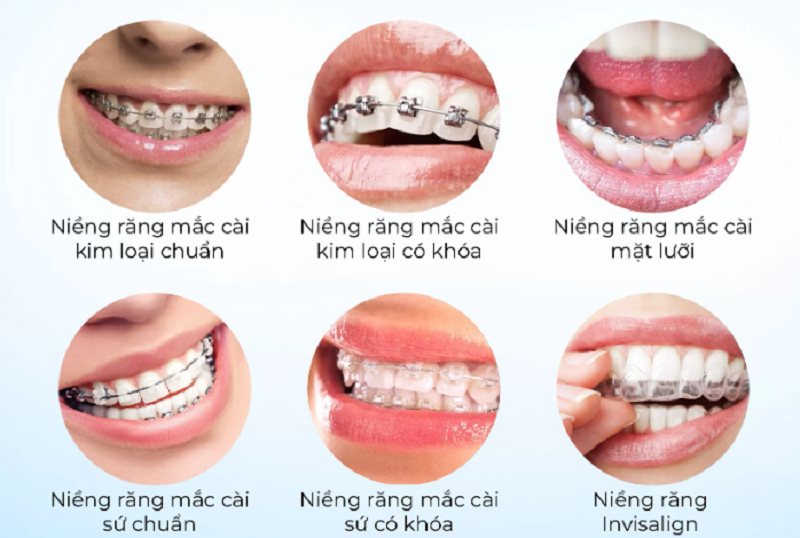 Các phương pháp niềng răng phổ biến cho trẻ
