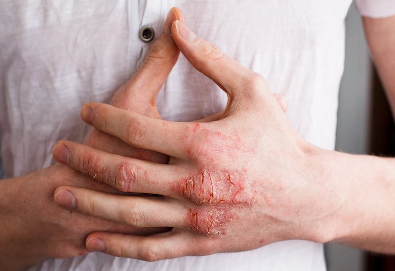 Tại sao da bàn tay bị viêm và xuất hiện nốt sần, mẩn đỏ, da bị tróc vảy?