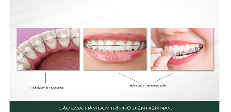 Các loại hàm duy trì thường dùng sau niềng răng