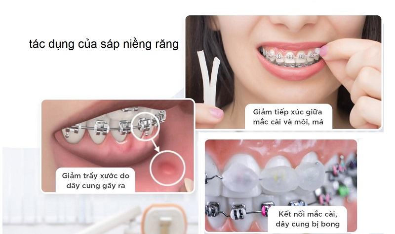 Một vài công dụng của sáp niềng răng