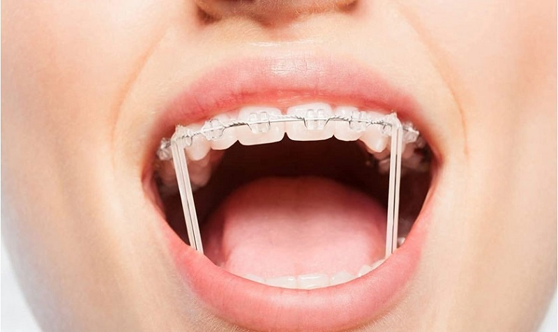 Dây thun niềng răng giúp hỗ trợ điều chỉnh răng về vị trí như ý muốn