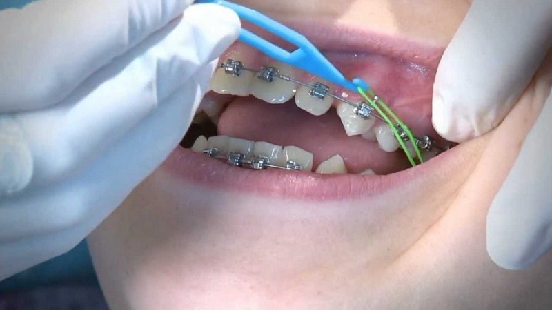 Khi dây thun niềng răng bị vàng, đã vệ sinh răng miệng sạch mà không khắc phục được thì nên khám nha sĩ để khắc phục hiệu quả