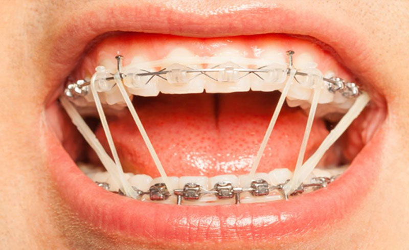 Dây thun niềng răng - một loại khí cụ được dùng để hỗ trợ chỉnh hình nha khoa