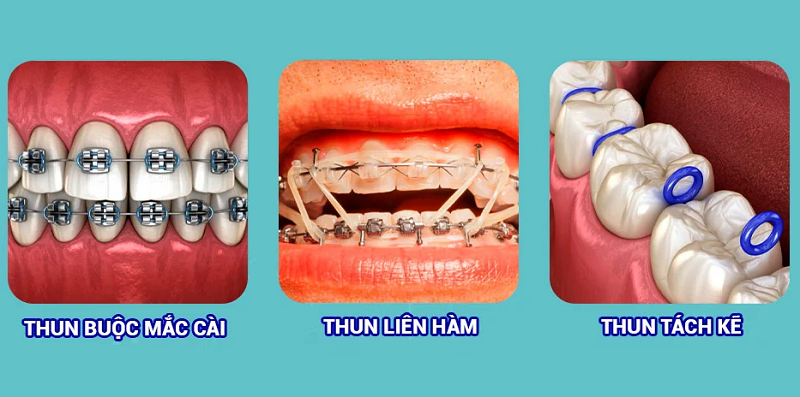 Một số loại dây thun niềng răng hay được sử dụng