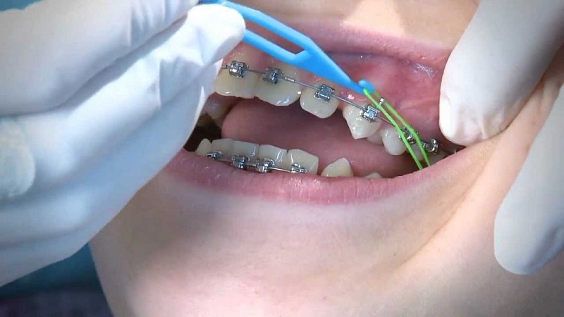 Nếu dây thun niềng răng bị hỏng hoặc có vấn đề bất thường thì nên đến nha sĩ để được khắc phục đúng cách