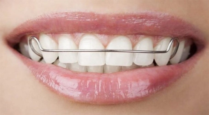 Tự chế dây thép theo hình dáng của khí cụ chỉnh nha để niềng răng tại nhà được một số người sử dụng