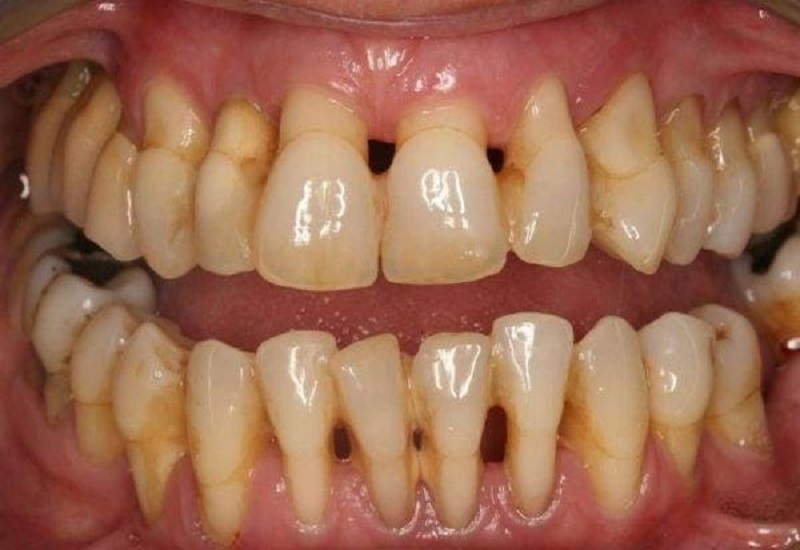 Viêm nha chu nặng và không điều trị là nguy cơ gây ra hiện tượng mất răng toàn hàm 
