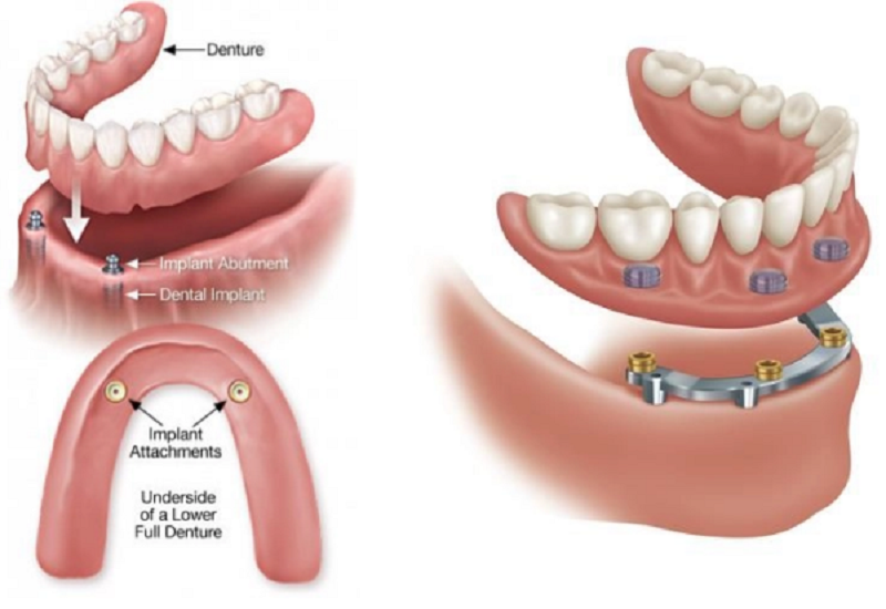 Cấy ghép implant khắc phục mất răng toàn hàm