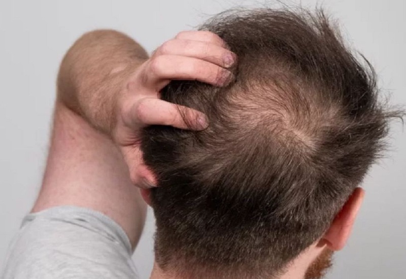 Viêm nang lông da đầu có thể xuất hiện như thế nào trên da?