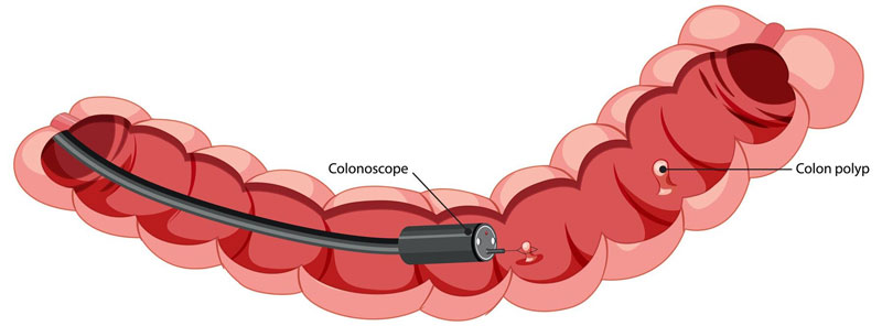 Polyp đại tràng gồm một khối các tế bào nhỏ ở trong lòng đại trực tràng