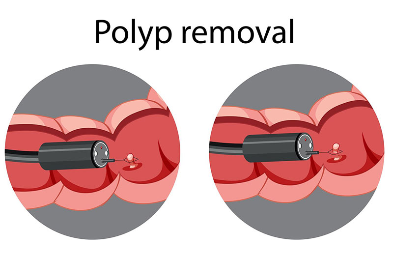 Cắt polyp đại tràng thường được thực hiện cùng lúc với nội soi