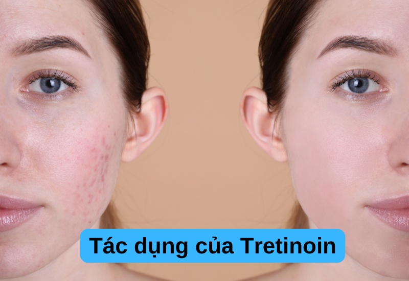 Tretinoin giúp cải thiện tình trạng mụn trứng cá, giúp da căng bóng và trắng sáng