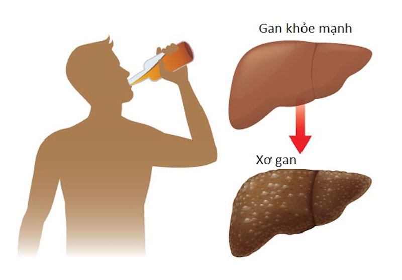 Người lạm dụng bia rượu thường có tỷ lệ mắc bệnh xơ gan cao