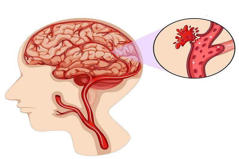 Người bị bệnh tim thiếu máu cục bộ rất dễ gặp tình trạng rối loạn nhịp tim