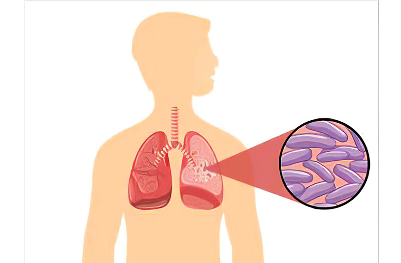 Có những cách nào để phân biệt ho khạc đờm của bệnh lao phổi so với ho do các bệnh phổi khác?
