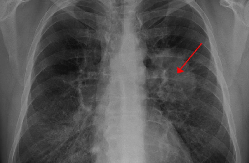 U phổi có thể lan sang các cơ quan khác trong cơ thể không?
