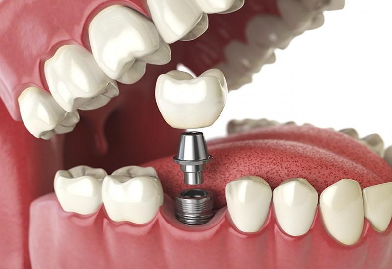 Trồng răng implant có nhiều ưu điểm