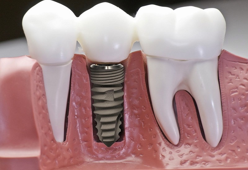 Trồng răng công nghệ implant - Phương pháp phục hình răng đem lại nhiều ưu điểm cho người sử dụng