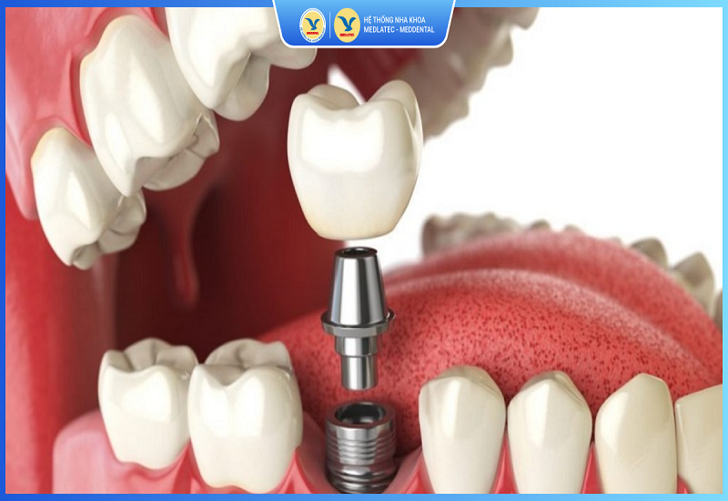 Trồng răng công nghệ implant tại Hệ thống Nha khoa MEDDENTAL