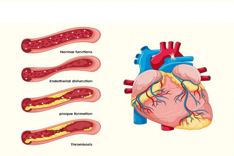 Hình ảnh minh họa về xơ vữa động mạch gây thiếu máu cơ tim