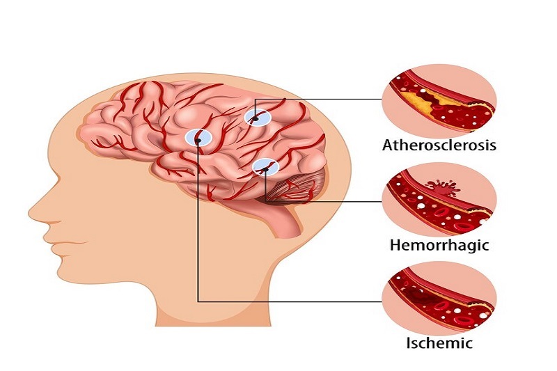 Mô phỏng về nguyên nhân và nguy cơ biến chứng thiếu máu não